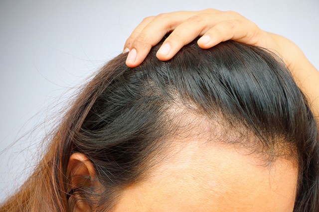 Qué tipos de alopecia afectan más a las mujeres? - Guatediario.com